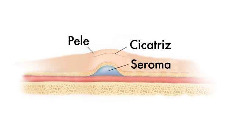 Seroma: o que é, sintomas, causas e tratamento - Tua Saúde